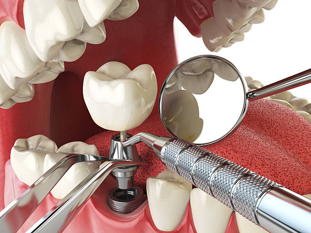 Best Emergency Tooth Extraction in Alamo Heights, TX